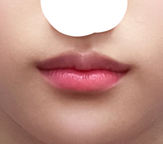 입술성형 만족입니다ㅎㅎ