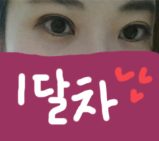 눈매교정이랑 절개쌍수 전후사진 들고 왔어요~^^