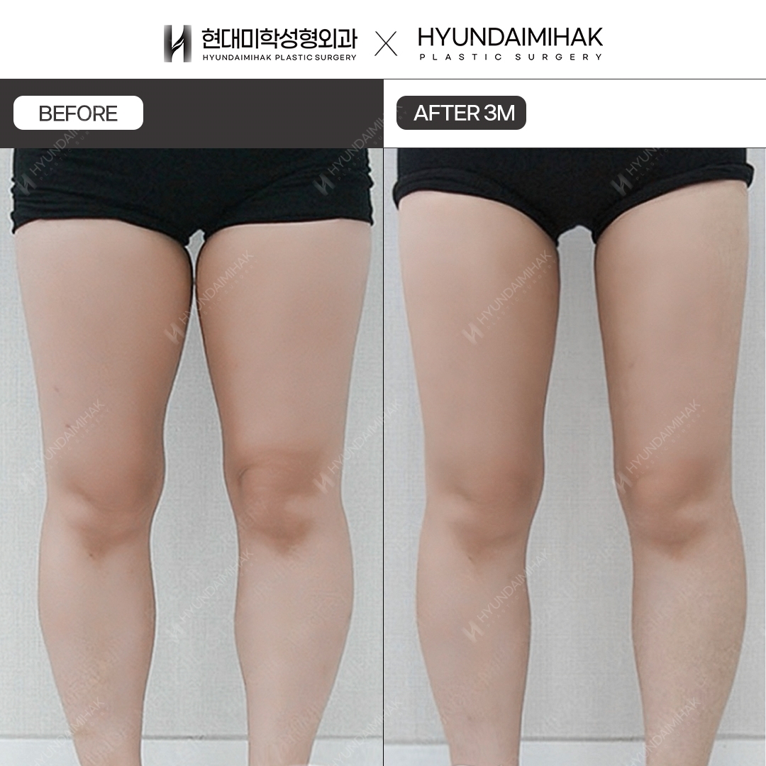 허벅지 지방흡입 3개월차