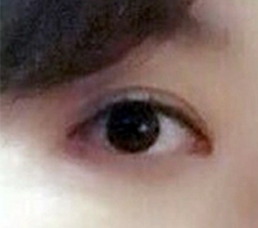 재수술 대박 성공 ㅠㅠㅠ