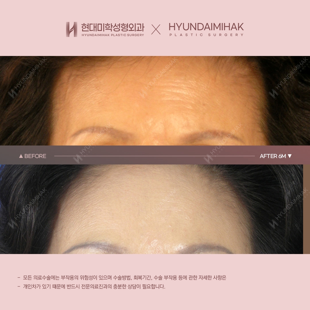 [동안성형] 이마거상리프팅 6개월 차