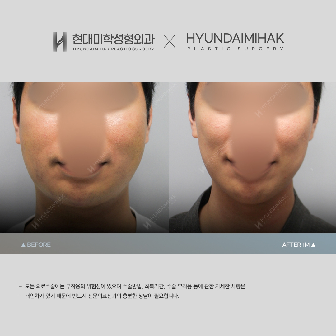 [동안성형] 실리프팅 1개월 차