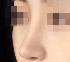 코수술 예쁘게 하고 싶은 사람 현대미학 추천합니다!!!!!