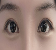 매몰쌍수가 풀려 황호 원장님께 절개쌍수재수술 했어요