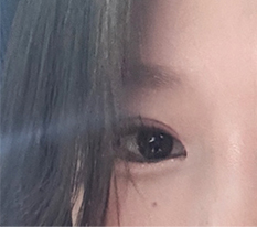 짝눈 교정은 쌍수가 답ㅎㅎ