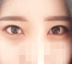 눈밑뒷트임해쪄연!!!!