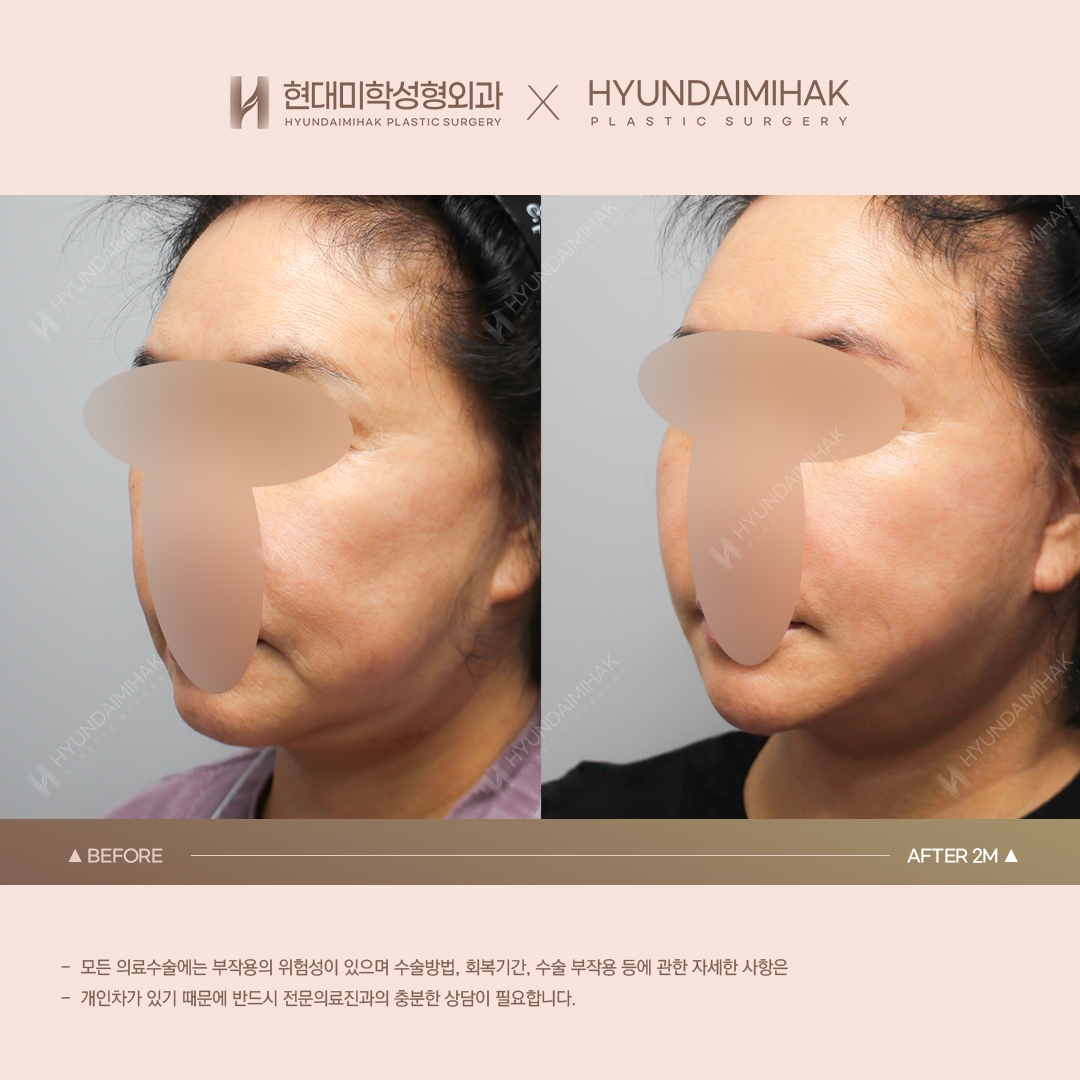[동안성형] 실리프팅 2개월 차