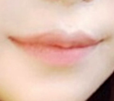 홍원장님께 받은 입꼬리수술~~~~
