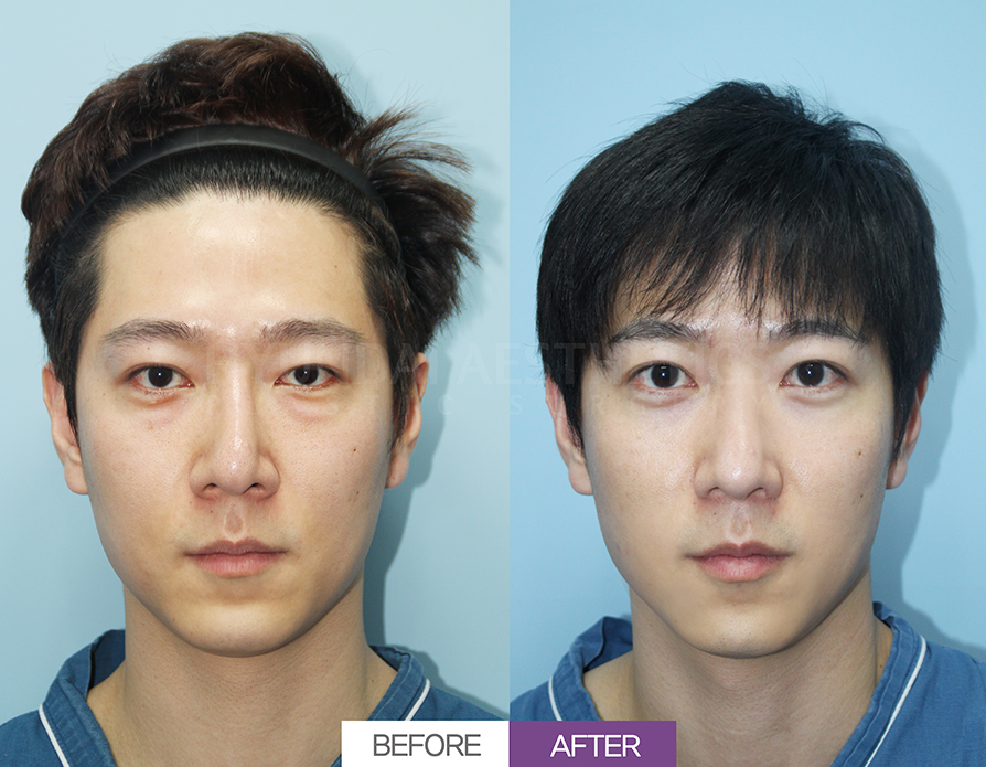 절개쌍꺼풀 + 눈매교정