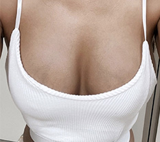 현대미학에서 가슴수술한지 벌써 6개월이나 지났어요!