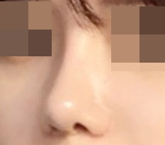 코 재수술후기입니당