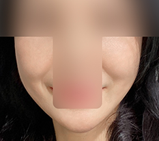 실리프팅 만족합니다