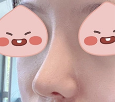 코재수술 한지 드디어 6개월차 접어들었습니당 ㅎㅎ