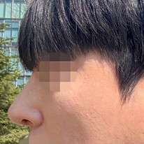 남자 매부리코성형
