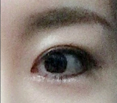 눈재수술 완전 성공 ^^