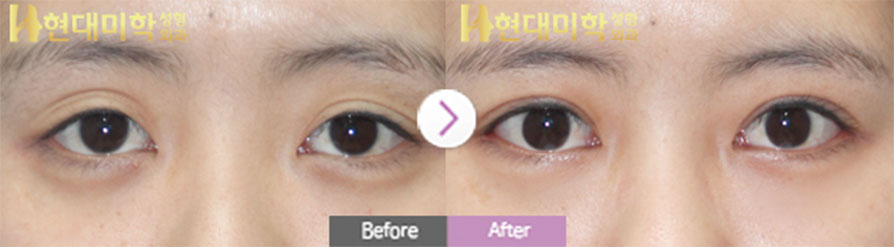 눈절개 재수술, 눈매교정, 뒤트임, 밑트임