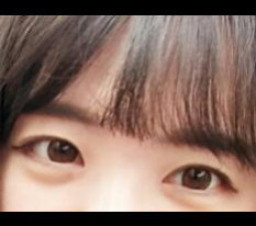 트임수술 후기~*