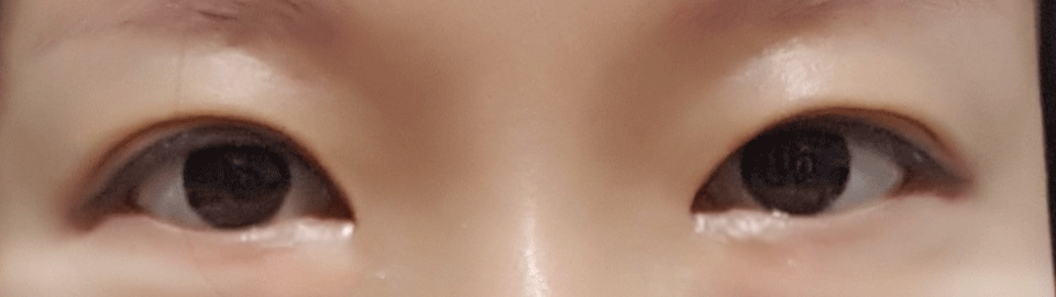 절개눈매교정 / 앞트임 1달차 후기~