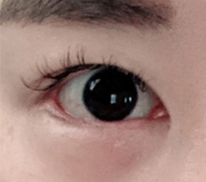 뒤트임 밑트임 재수술 만족도 10000%