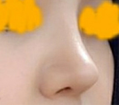 둥글고 뭉뚝한 코 오똑코 됐어요 ㅎㅎ