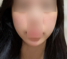 실리프팅 자연스럽게 잘 됐어룡