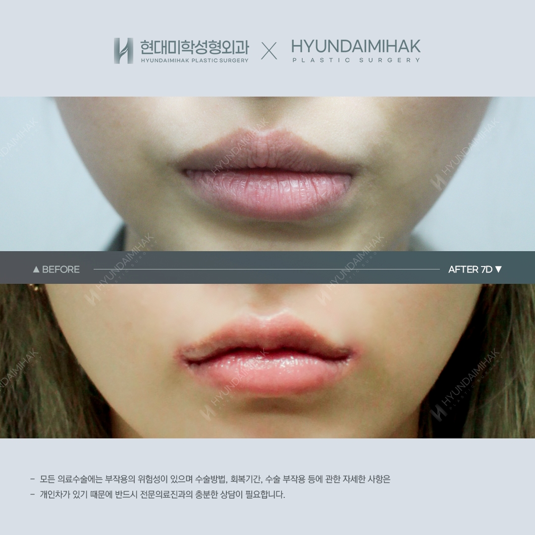 [입술성형] 큐피트라인, 비대칭교정 7일 차