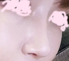 코재수술 후기에용~