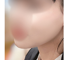 지방킬주사 효과 좋네요