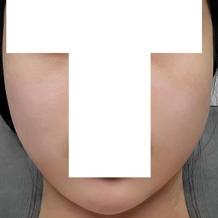 얼굴살처짐 실리프팅으로 완벽하게 개선했어요