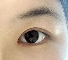 눈성형 후기 들고 왔어요 ^q^