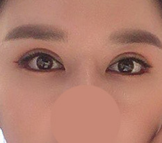 눈재수술 한달차 ㅋ 이 정도면 성공이죠?? ^^