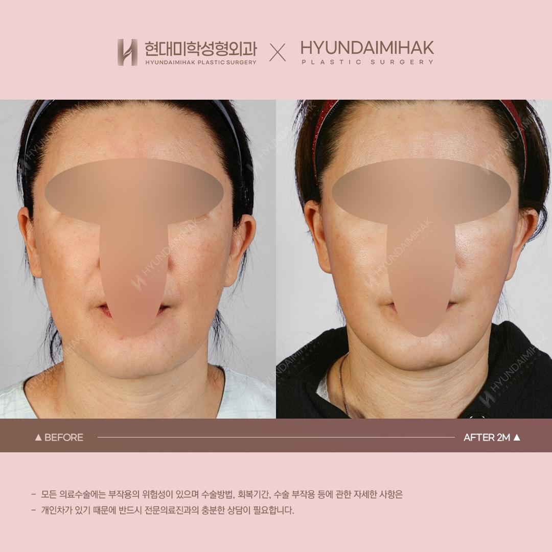 [동안성형] 실리프팅 2개월 차
