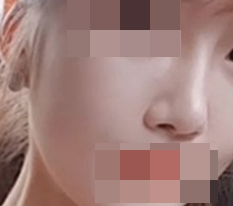 코재수술 했습니다:)