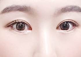 눈성형은 현대미학에서 고고링~
