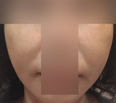 실리프팅 이게 되네요?