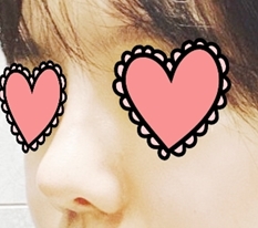 코재수술 라인 제대로 만족함!!