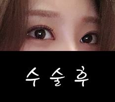 눈매교정 재수술했구 트임까지 한 번에 이번에 다 했어요 봐주세요