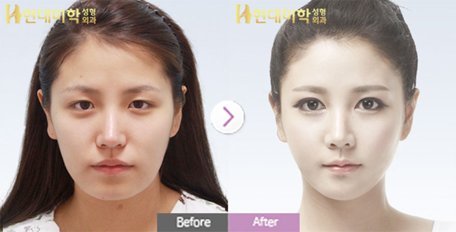눈성형, 코성형, 양악수술