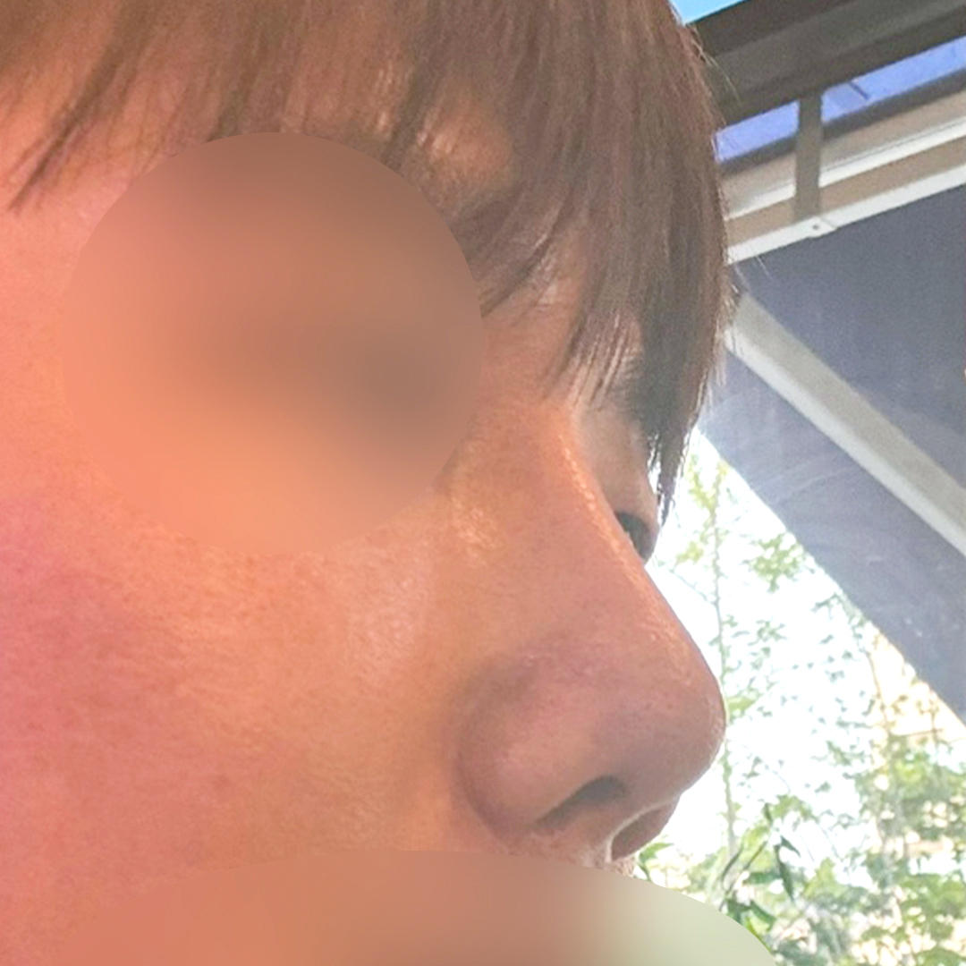 남자코성형 1개월
