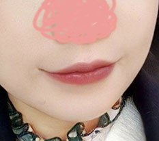 입꼬리수술 두달차 후기 올렸었는데 세달 지나서 세달차 후기도 올려봐용><