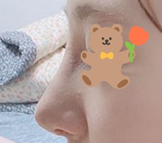 코수술 7일차때 후기 올려요