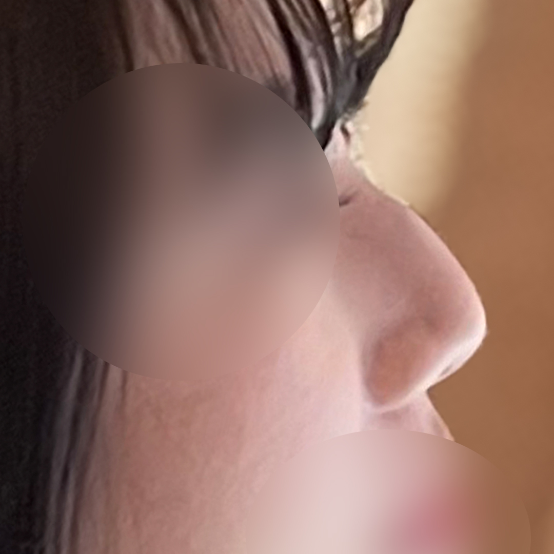 매부리코성형 전후
