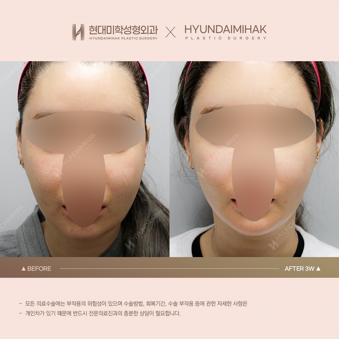 [리프팅] 이중턱 실리프팅 3주 차