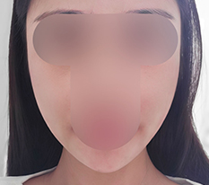 처진 살 확 당겼어용
