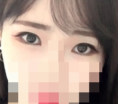 현대미학 눈매교정 완죠니 만족중♥