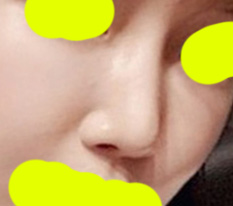 코재수술 완뇨 미션 석세스~_~