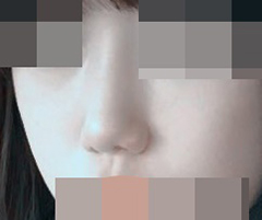 콧볼수술했어용!!