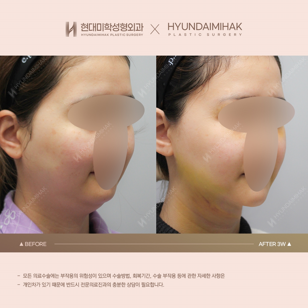 [리프팅] 이중턱 실리프팅 3주차