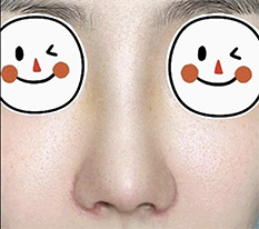 코수술 했어요 후기 올립니다 너무 잘됐어요 ^^