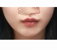 보톡스 대신 입꼬리수술